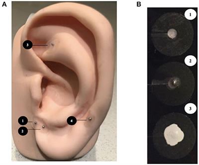 Magnetic Non-invasive Auricular Acupuncture During Eye-Exam for Retinopathy of Prematurity in Preterm Infants: A Multicentre Randomized Controlled Trial